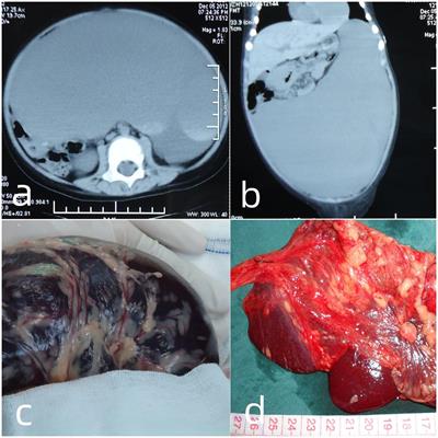 Toddler with giant omental cyst, profound anemia, and shock: case report and review of the literature